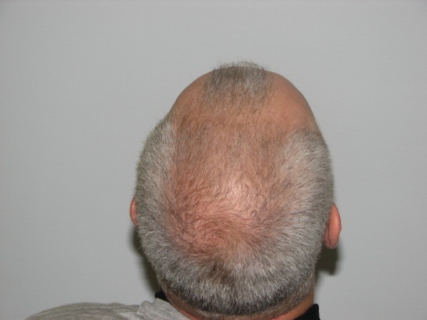 Click image for larger version
Name: 3500g pre op Crown.JPG
Size: 55.3 KB
ID: 11416