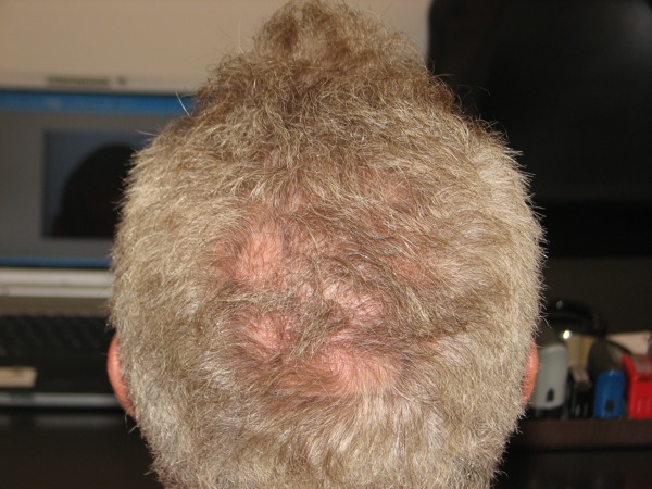 Click image for larger version

Name:	3500g FIT 1yr post op Crown.JPG

Size:	92.6 KB
ID:	11417