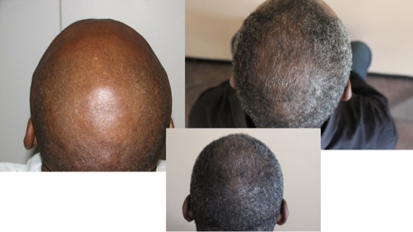 Click image for larger version

Name:	1686g_3wing-vertex-before,-7-mos-after.jpg

Size:	43.7 KB
ID:	11653
