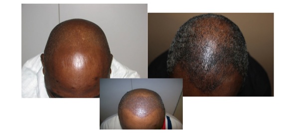 Click image for larger version

Name:	1686g_3wing-before,-immediate-post-op,-7-mo-post-op.jpg

Size:	26.8 KB
ID:	11654