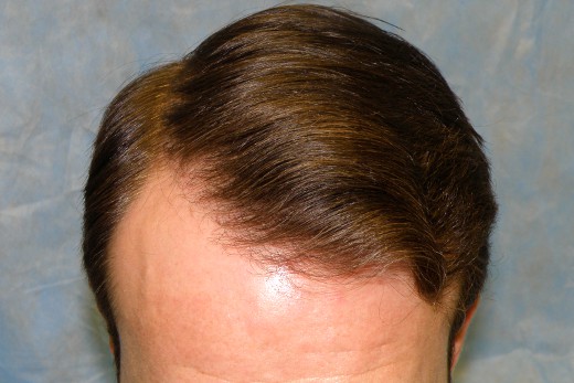 Click image for larger version

Name:	04_after-1st-hair-transplant-top-view.jpg

Size:	51.9 KB
ID:	15599