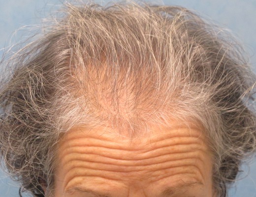Click image for larger version

Name:	03_before-hair-transplant.jpg

Size:	90.2 KB
ID:	15969