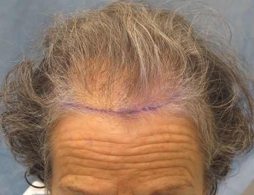 Click image for larger version
Name: 04_position-of-hairline.jpg
Size: 86.1 KB
ID: 15970