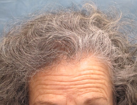 Click image for larger version

Name:	05_after-1st-hair-transplant.jpg

Size:	96.0 KB
ID:	15971