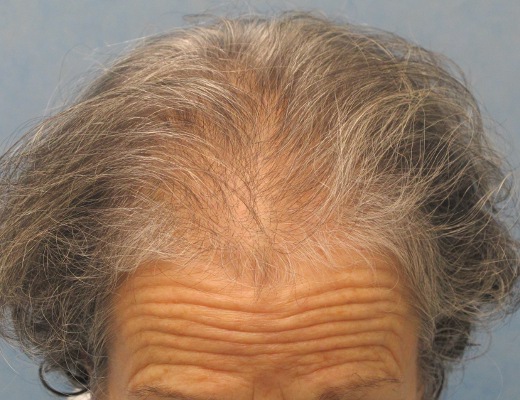 Click image for larger version
Name: 06_before-hair-transplant-top-view.jpg
Size: 87.0 KB
ID: 15972