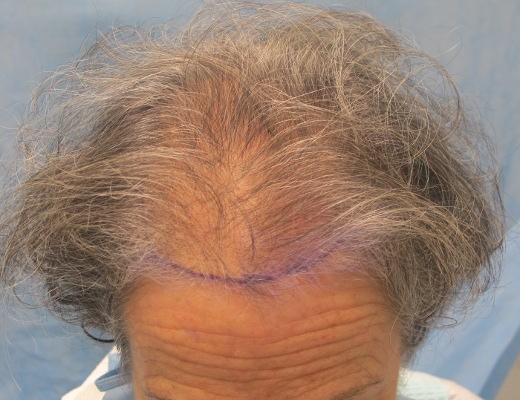 Click image for larger version
Name: 07_position-of-hairline-top-view.jpg
Size: 85.0 KB
ID: 15973