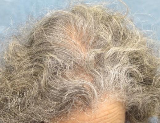 Click image for larger version

Name:	08_after-1st-hair-transplant-top-view.jpg

Size:	42.7 KB
ID:	15974