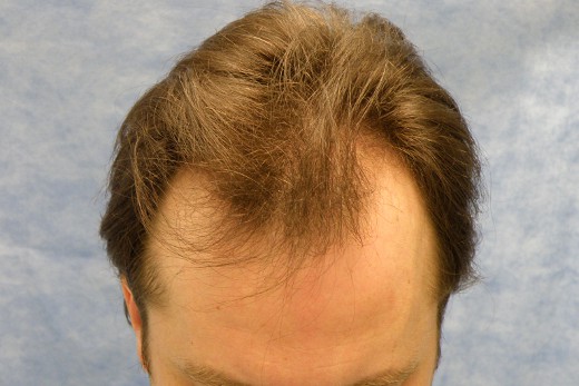 Click image for larger version
Name: 03_before-hair-transplant-top-view.jpg
Size: 52.2 KB
ID: 16132