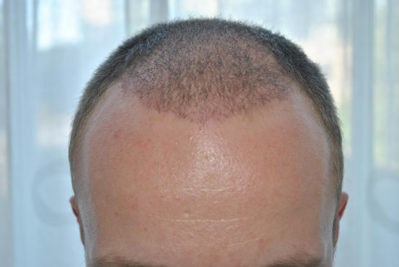 Click image for larger version

Name:	4 weeks post-op 001.jpg

Size:	85.2 KB
ID:	16363