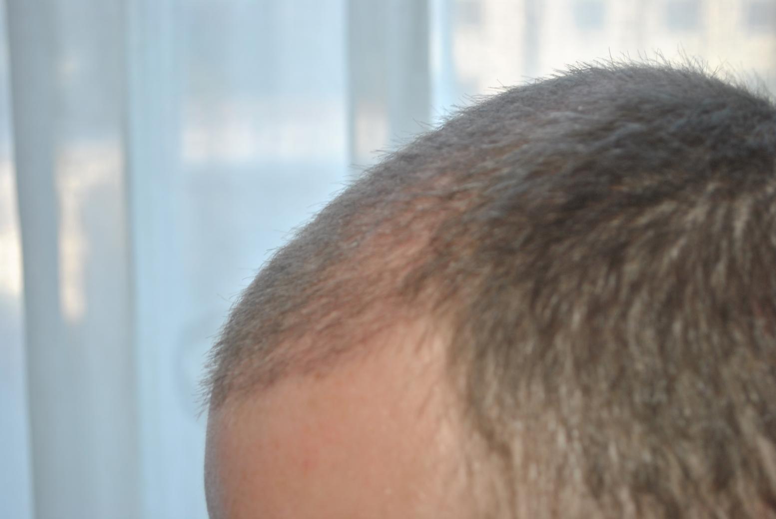 Click image for larger version

Name:	4 weeks post-op 002.jpg

Size:	76.3 KB
ID:	16364