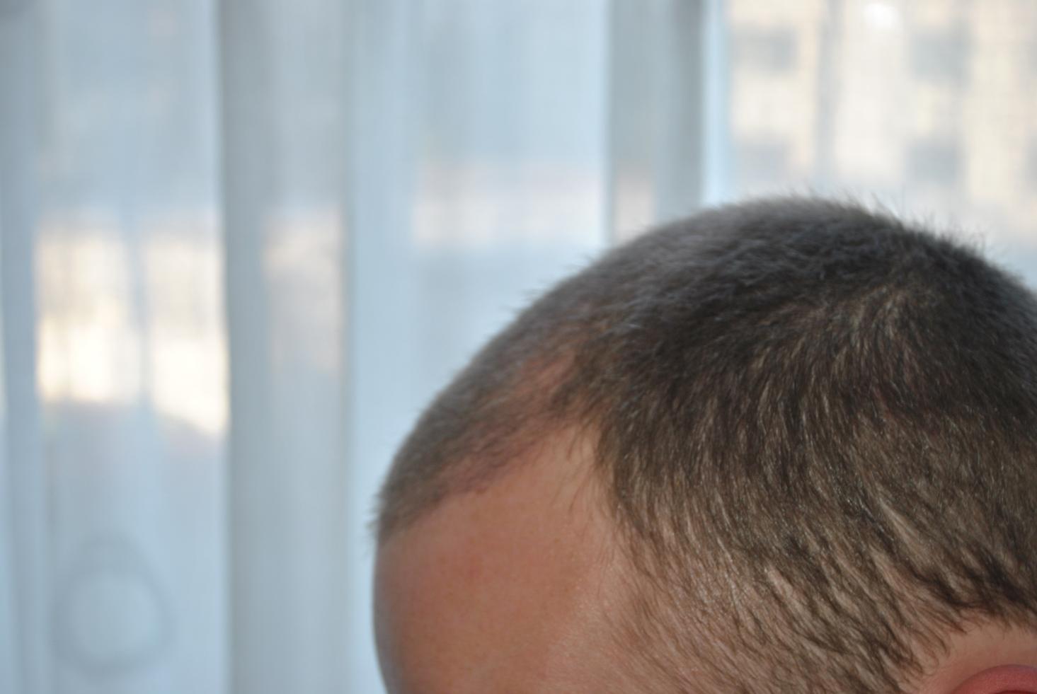 Click image for larger version

Name:	4 weeks post-op 003.jpg

Size:	79.6 KB
ID:	16365