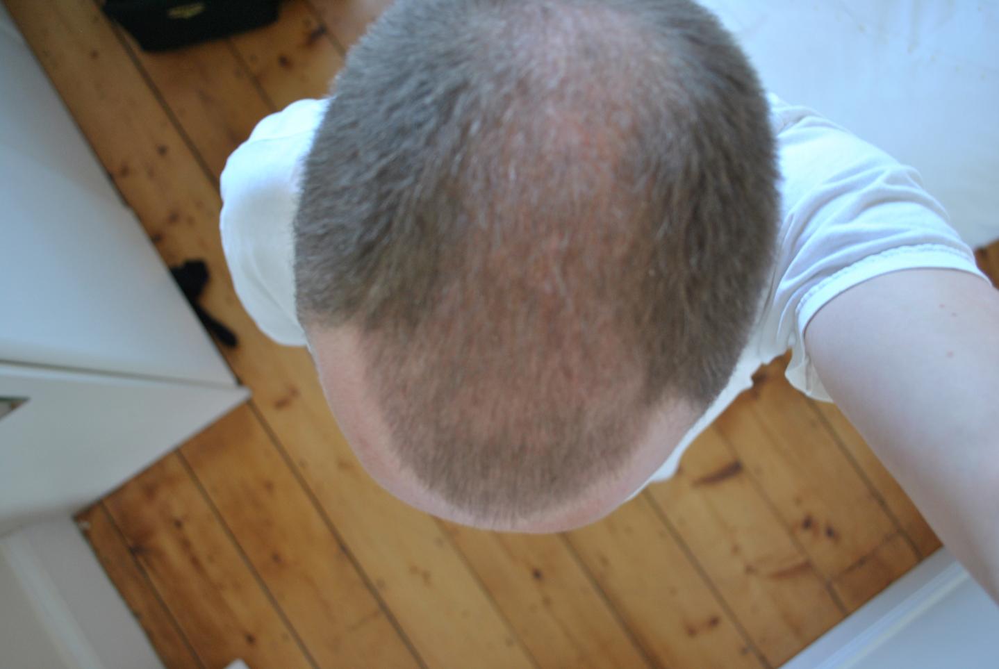 Click image for larger version

Name:	4 weeks post-op 004.jpg

Size:	79.0 KB
ID:	16366