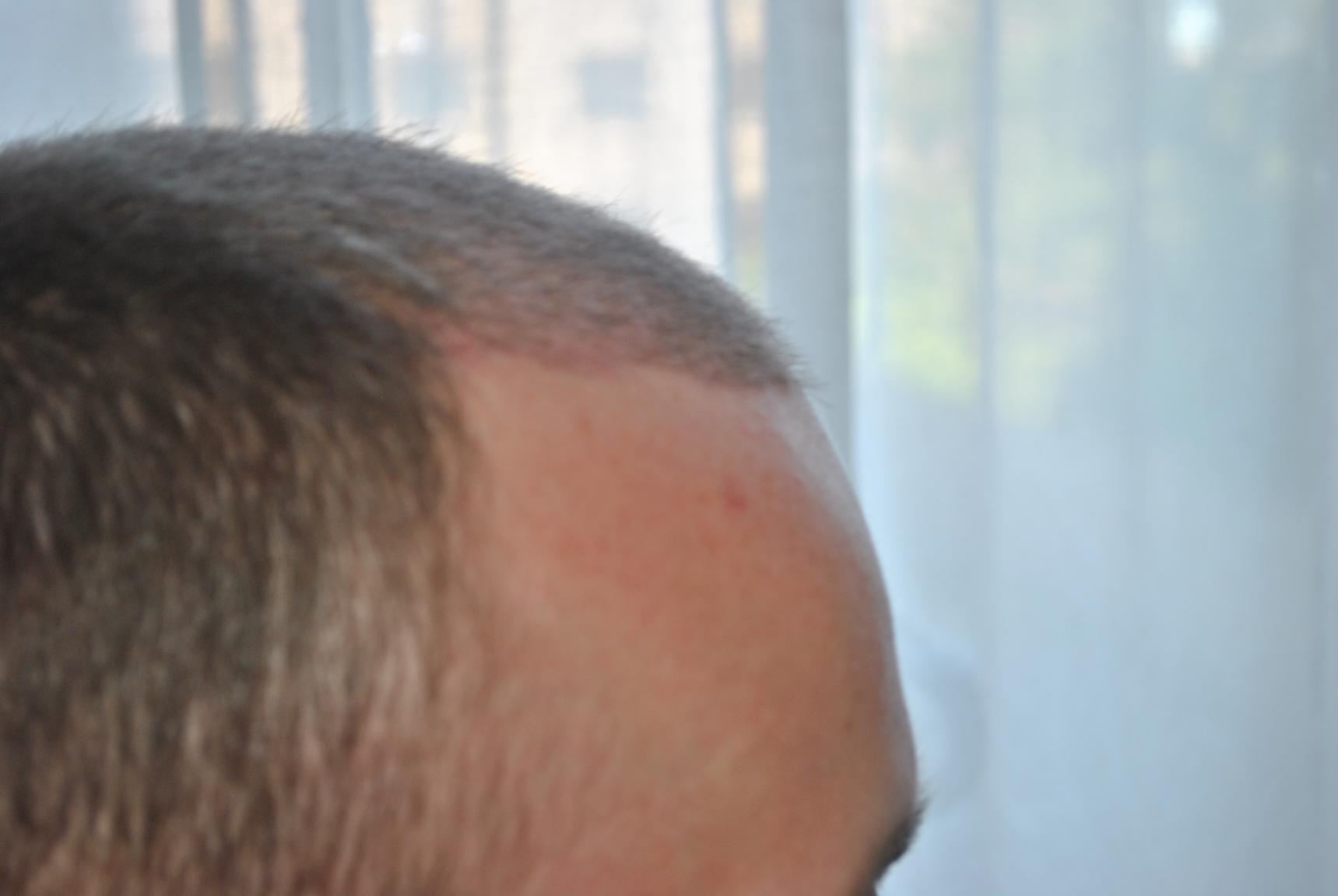 Click image for larger version

Name:	4 weeks post-op 005.jpg

Size:	75.3 KB
ID:	16367