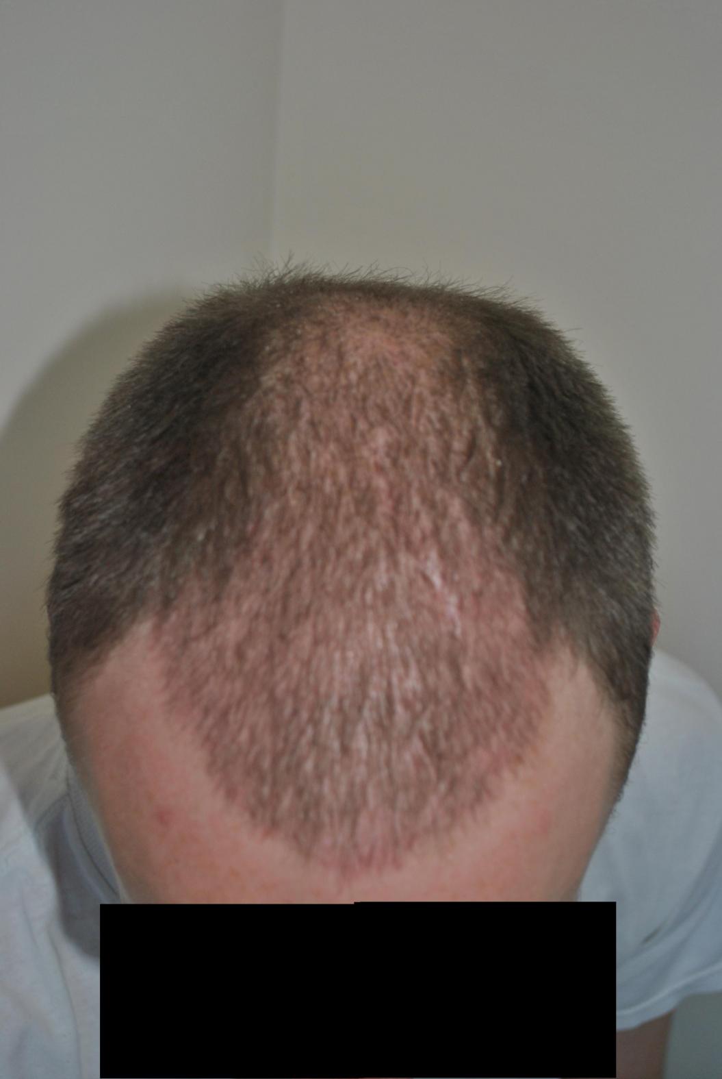 Click image for larger version

Name:	4 weeks post-op revised.jpg

Size:	78.5 KB
ID:	16368