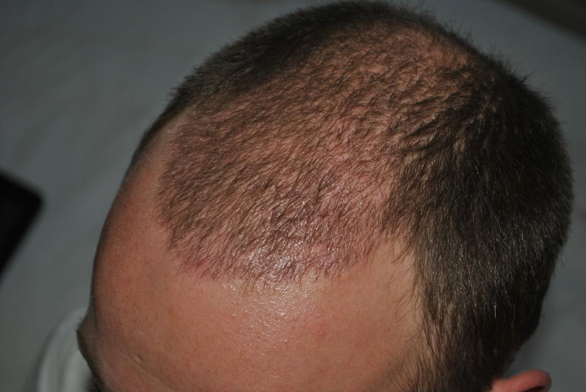 Click image for larger version

Name:	4 weeks post-op 007.jpg

Size:	94.5 KB
ID:	16369