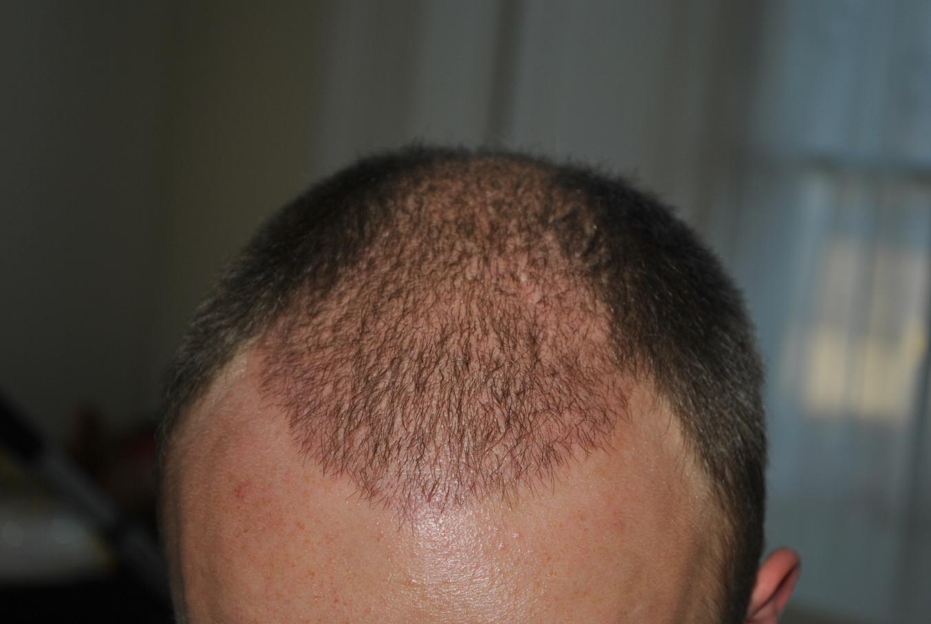 Click image for larger version

Name:	4 weeks post-op 008.jpg

Size:	90.2 KB
ID:	16370