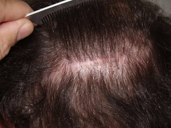 Click image for larger version

Name:	sixtocab-donor-scar0.jpg

Size:	96.3 KB
ID:	1656