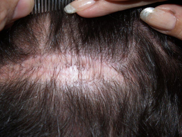 Click image for larger version

Name:	sixtocab-donor-scar1.jpg

Size:	91.9 KB
ID:	1657