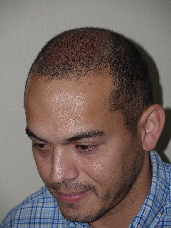 Click image for larger version

Name:	samvelazquez 1 day after1.jpg

Size:	65.1 KB
ID:	2077