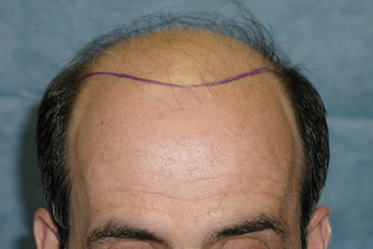Click image for larger version

Name:	Position of the Hairline.jpg

Size:	19.4 KB
ID:	253