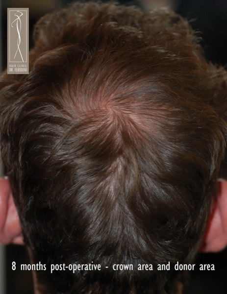 Image uploaded by: Dr Feriduni Hair Clinic