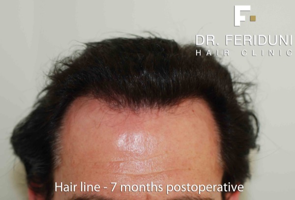 Image uploaded by: Dr Feriduni Hair Clinic