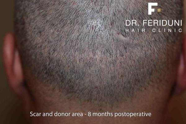 Image uploaded by: Dr Feriduni Hair Clinic