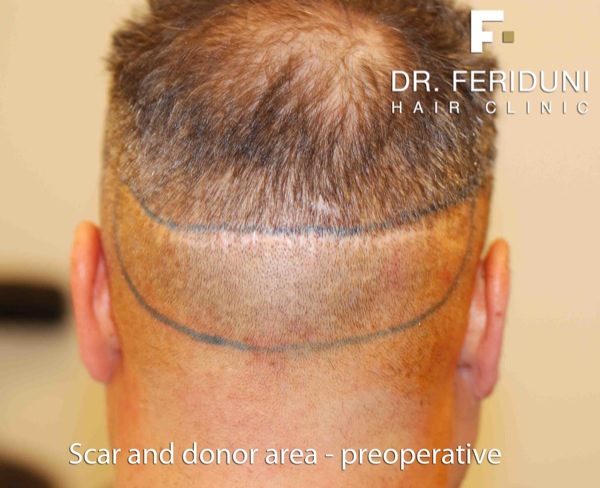 Image uploaded by: Dr Feriduni Hair Clinic