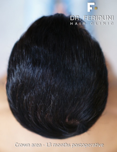 Image uploaded by: Dr Feriduni Hair Clinic