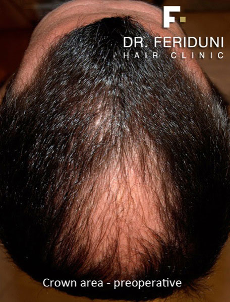 Image uploaded by: Dr Feriduni Hair Clinic