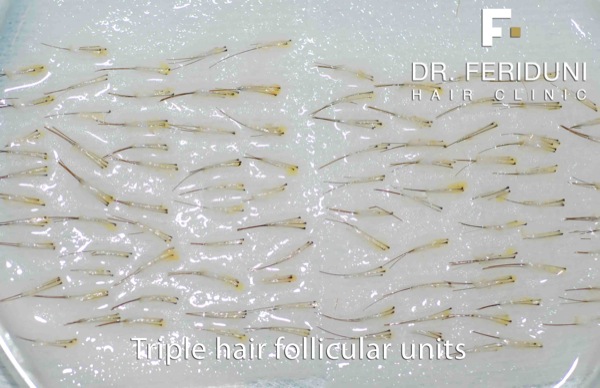 Image uploaded by: Dr Feriduni Hair Clinic