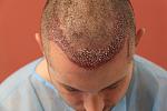 Image uploaded by: druginducedhairloss