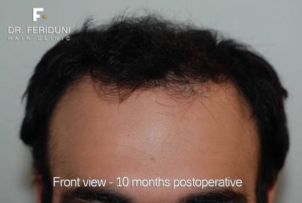 Image uploaded by: Dr Bijan Feriduni Hair Clinic