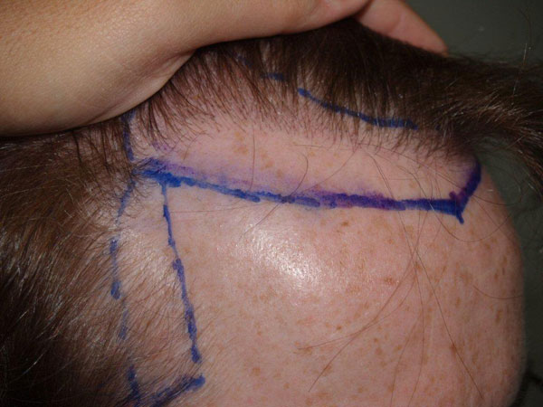 Click image for larger version

Name:	johnmurph-before-hair1.jpg

Size:	55.1 KB
ID:	3123