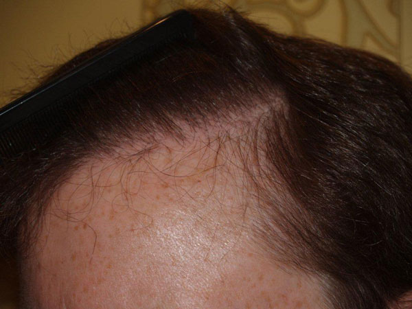Click image for larger version

Name:	johnmurph-aft-hairline-c1.jpg

Size:	50.3 KB
ID:	3125