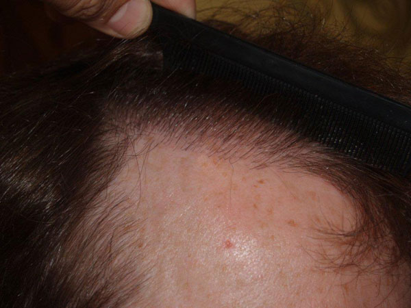Click image for larger version

Name:	johnmurph-aft-hairline-c0.jpg

Size:	48.7 KB
ID:	3126