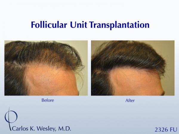 Here is a 42-year-old man who wanted the fullness of his hairline back.  The results of a 2326-graft session with Dr. Wesley can be seen at 11 months after his surgery.  The patient is ecstatic.

a video of his transformation may be viewed at https://vimeo.com/70521041