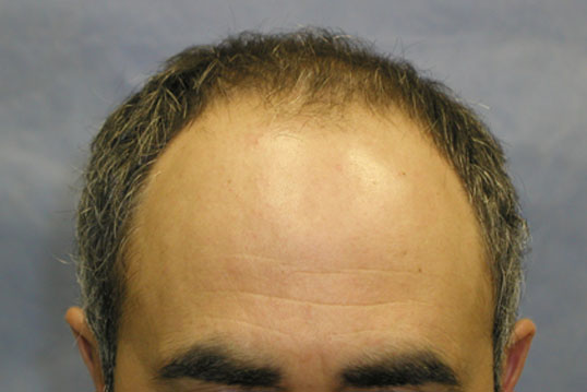 Click image for larger version

Name:	Patient Hairline Before Surgery.jpg

Size:	32.5 KB
ID:	342