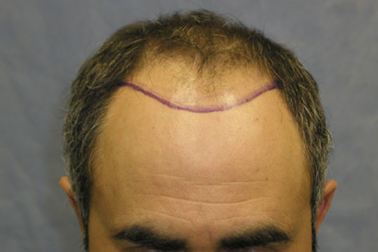 Click image for larger version

Name:	Position of hairline.jpg

Size:	30.9 KB
ID:	343