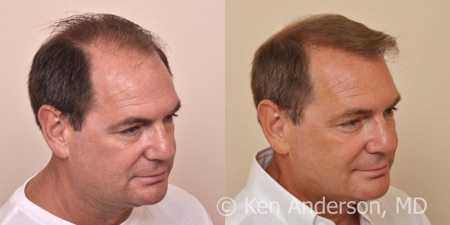57 year old man who had an ARTAS Robotic Hair Transplant by Dr. Ken Anderson, at the Anderson Center for Hair in Atlanta, Georgia.