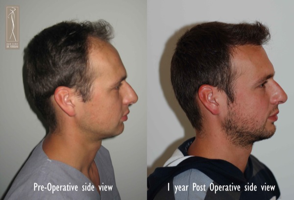 Click image for larger version

Name:	Patient 1 - pre and post side view 2.jpg

Size:	55.1 KB
ID:	4790