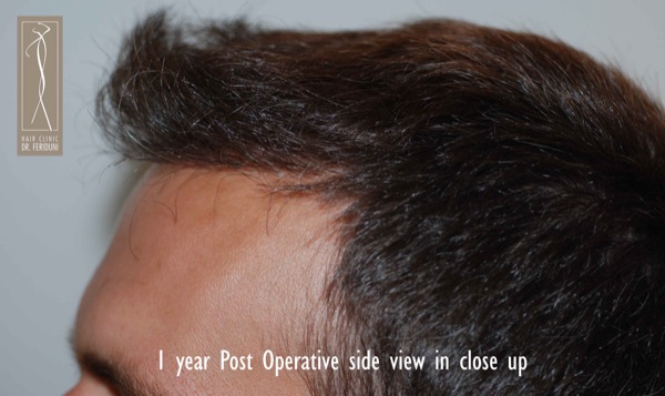 Click image for larger version

Name:	Patient 1 - post operative side view.jpg

Size:	64.5 KB
ID:	4791