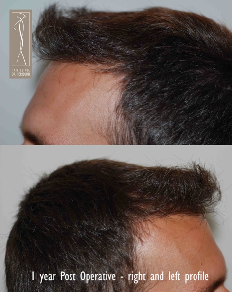 Click image for larger version
Name: Patient 1 - post operative right and left profile.jpg
Size: 87.3 KB
ID: 4794