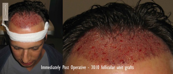 Click image for larger version
Name: Patient 1 - immediately post operative.jpg
Size: 52.2 KB
ID: 4796