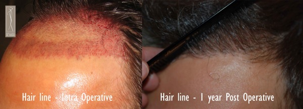 Click image for larger version

Name:	Patient 1 - hair line intra and post.jpg

Size:	45.2 KB
ID:	4797