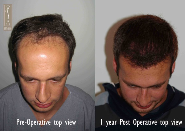 Click image for larger version
Name: Patient 1 - pre and post top view.jpg
Size: 63.7 KB
ID: 4798
