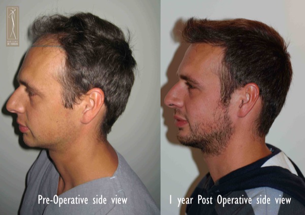 Click image for larger version

Name:	Patient 1 - pre and post side view.jpg

Size:	67.6 KB
ID:	4799