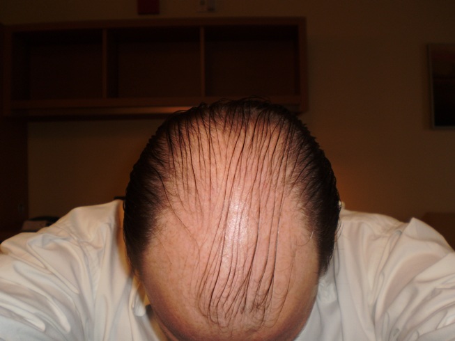 Click image for larger version

Name:	PreOpHead.JPG

Size:	76.4 KB
ID:	5187