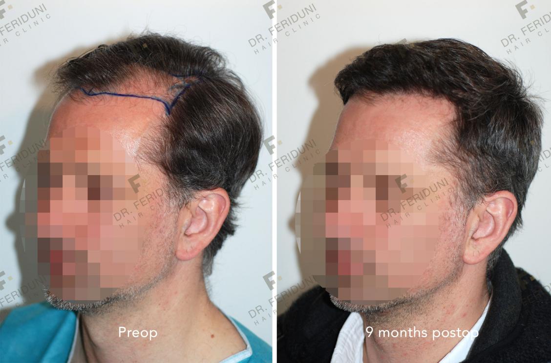 Image uploaded by: Dr Feriduni Hair Clinic