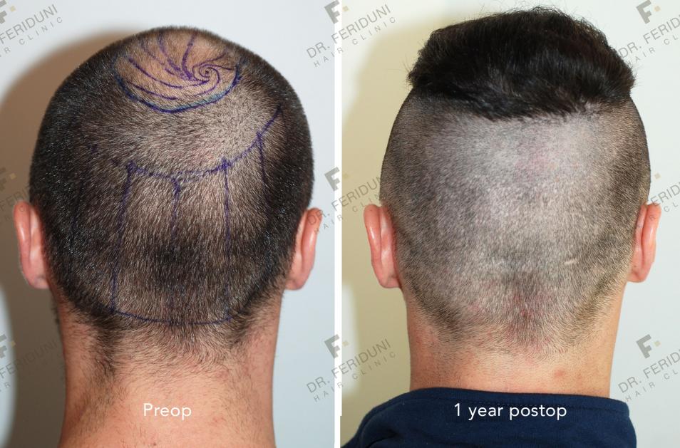 Image uploaded by: Dr Feriduni Hair Clinic